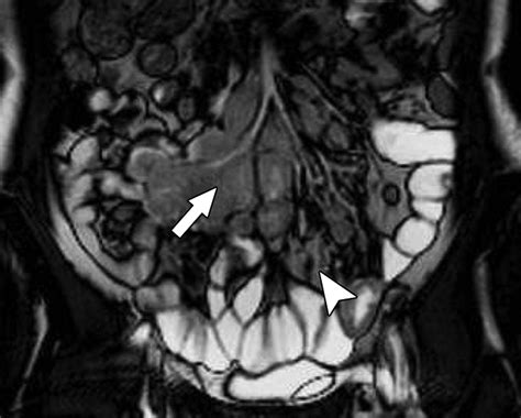 Mr Enterography Of Small Bowel Lymphoma Potential For Suggestion Of