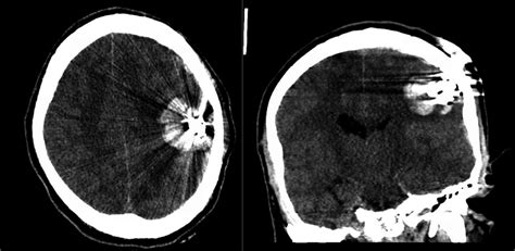 Admission Head Ct Axial Head Computed Tomography Left And Coronal