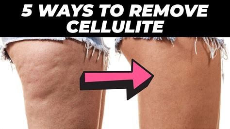 Easy Ways To Get Rid Of Cellulite For Good Youtube