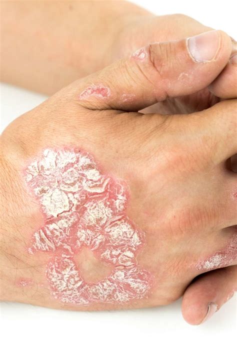 Plaque Psoriasis Pictures Symptoms And Severity