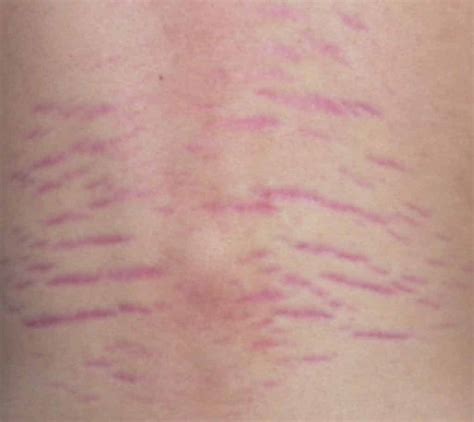 The Difference Between Red And White Stretch Mark Sculptdtlacom