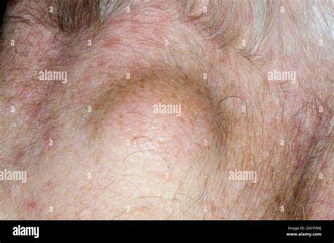 Sebaceous Cyst On The Back Of The Neck Of An 82 Year Old Male Patient