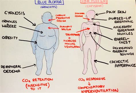 They are usually caused by smoking, but can also be attributed to air pollution. Blue Bloater (Chronic Bronchitis) vs. Pink Puffer ...