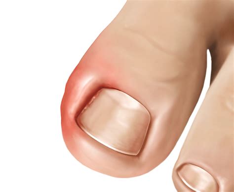 Ingrown Toenail Surgery And Treatment Spine And Orthopedic Center