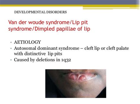 Disorders Of Lip
