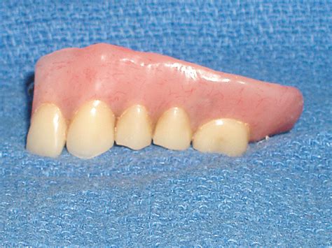 Dental Implants Austin Dentist Mike Williamson Dds Ms