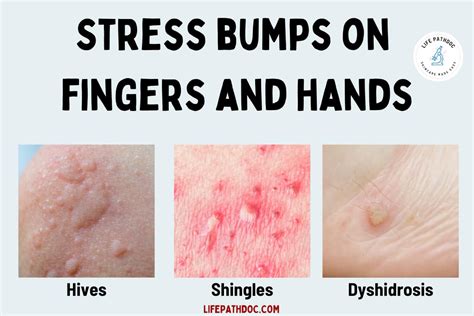 Stress Bumps On Fingers Pictures Causes Treatment