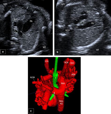 Three Vessel And Tracheal View On Fetal Echocardiography A Left Sided