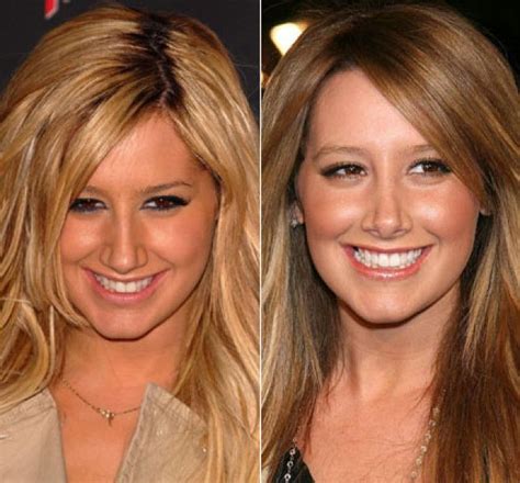 Ashley Tisdale Nose Job Before And After Nose Job Ashley Tisdale
