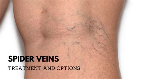 Spider Veins Treatment Options And Symptoms Jacksonville Vein Clinic