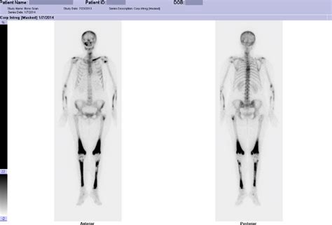 Whole Body Bone Scintigraphy High Uptake On Long Bones Distal Femoral