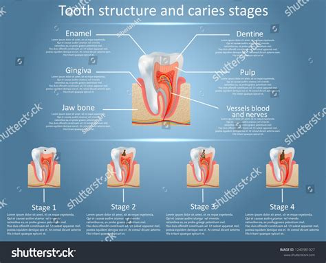 Human Tooth Structure Vector Diagram And Caries Stages Dental Anatomy
