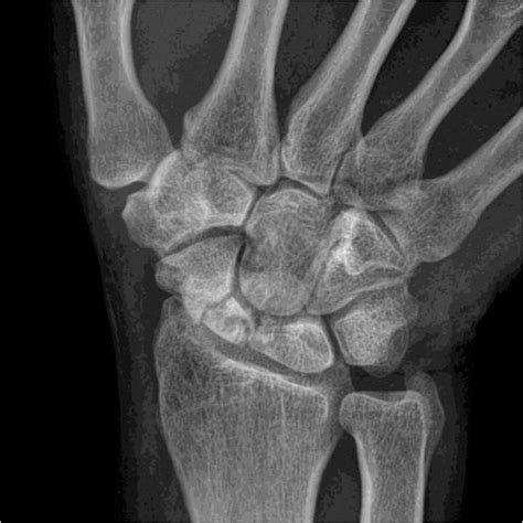 Wrist Arthritis Slac And Snac Zaf Naqui