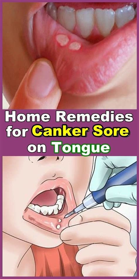Home Remedies For Canker Sores On Tongue Diy And Crafts