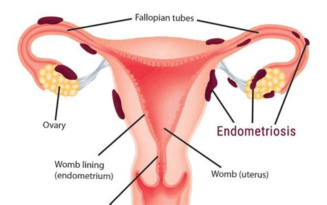Endometriosis Gynoveda