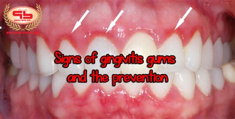Signs Of Gingivitis Easy To Identify And The Prevention