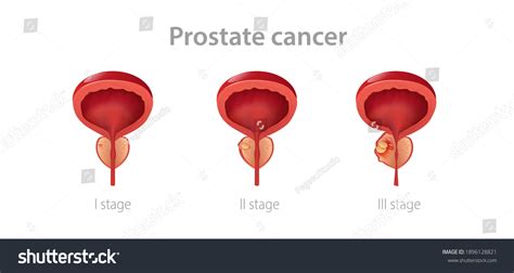 Stages Prostate Cancer Disruption Male Gland Stock Vector Royalty Free Shutterstock