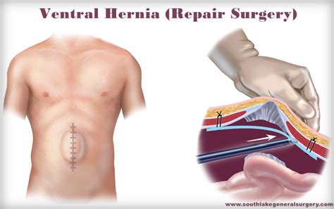 Ventral Hernia Symptoms Surgery And Complications Southlake General