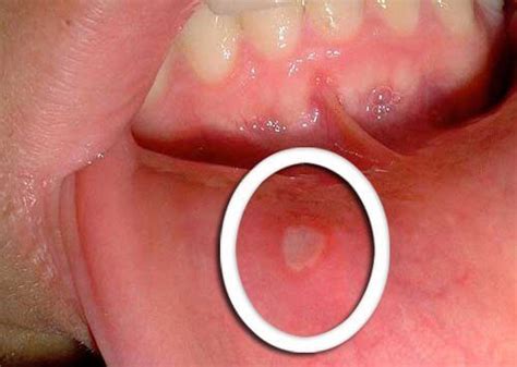 Rak Jamy Ustnej I Gardła Groźne Objawy Krok Do Zdrowia