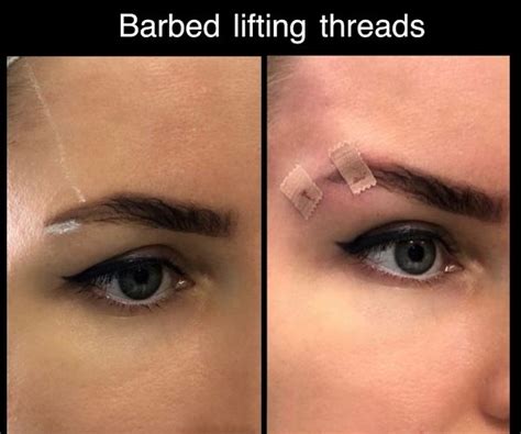 Fox Eye Thread Lift Side Effects︱yastrid Advanced Pdo Thread