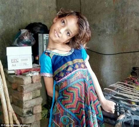 pakistani girl s head hangs at a 90 degree angle daily mail online