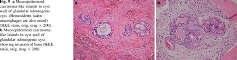 A Mucoepidermoid Carcinoma Like Islands In Cyst Wall Of Glandular