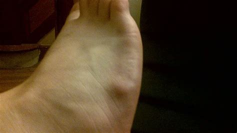 What Is This Lump On Top Of My Foot Ganglion Cysts Delray Beach Podiatry