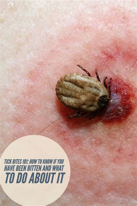 Tick Bites Can Lead To Lymes Disease And Its Super Important To Be