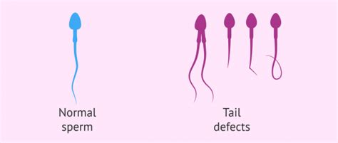 Tail Defects In Sperm