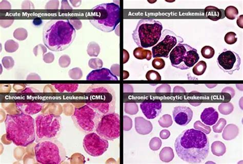 What Are The Types Of Leukemia — Medipulse Best Private Hospital In