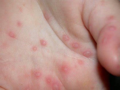 Hand, foot, and mouth disease (hfmd) is a common infection caused by a group of viruses. Surviving Residency & Motherhood: Hand, Foot, & Mouth... YUCK!