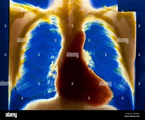 False Colour Normal Chest X Ray Showing A Normal Heart Protruding To