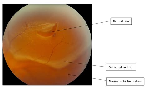 Jan 23, 2018 · rhegmatogenous retinal detachment is a break, tear, or hole in the retina. Retinal Detachment | Ophthalmology | Geeky Medics