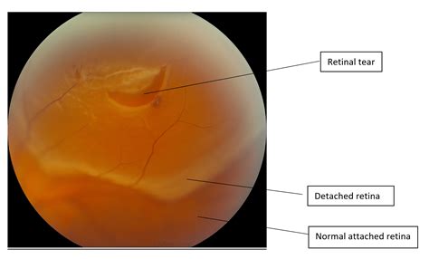 Svetlana pilyugina, a retina specialist at assil eye institute of los angeles, discusses retinal tears: Retinal Detachment | Ophthalmology | Geeky Medics