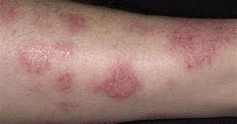 Gejalanya adalah kulit merah, gatal dan. Eczema Cara Merawat dan Mengatasi dengan Vitamin Shaklee ...