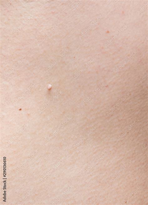 Pedunculated Skin Tag Or Acrochondon Or Soft Fibroma Papilloma On Human Skin Wart