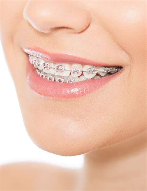 Types Of Braces West London Orthodontist Orthosmile
