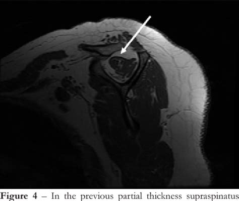 Figure 4 From Magnetic Resonance Imaging Mri Spectrum Of Rotator Cuff