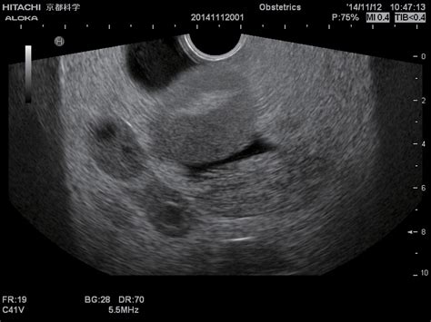 Ultrasound imaging has shown an extremely rapid evolution in the last two decades, thanks to the development of highly. Female Pelvic Ultrasound Phantom at Imaging Solutions ...