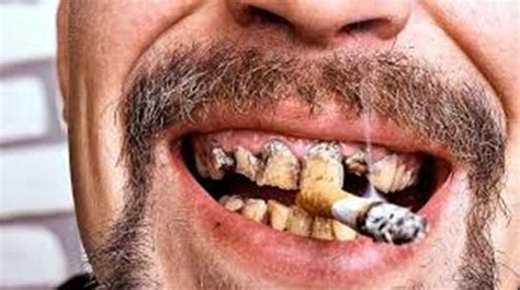 Smoking And Oral Cancer