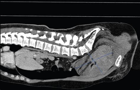 Embolization in the Treatment of a Major Retropubic ...
