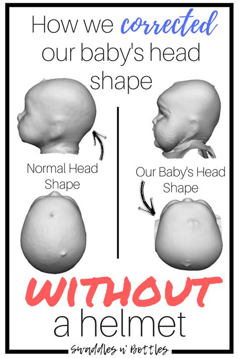 How We Fixed Our Babys Flat Head Without A Helmet