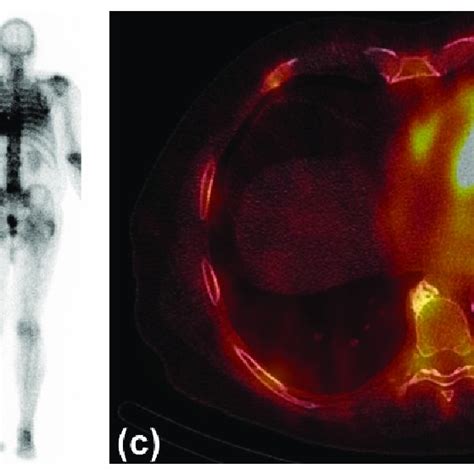 Typical Findings In Scintigraphy And Single Photon Emission Computed Download Scientific