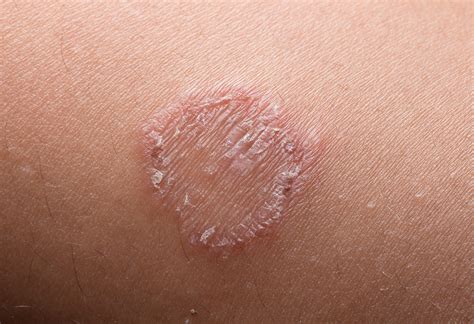Ringworm In Children Reasons Symptoms And Treatment