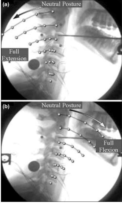 Translational Motion Of Each Cervical Vertebra In A Extension And B
