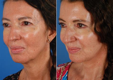 The Uplift™ Lower Face And Neck Lift Photos Naples Fl Patient 10636