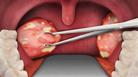 How To Treat White Spots On Tonsils At Home Home