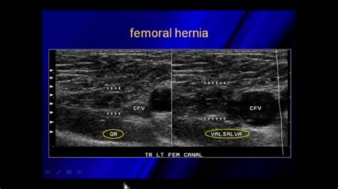Ultrasound Of Hernias Radiology Ultrasound Lockscreen Screenshot