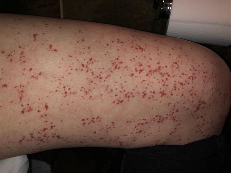Patricia Walsh News Blood Spots On Skin Pictures