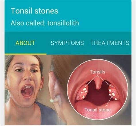 Symptoms Of Mono Throat Symptoms Of Disease
